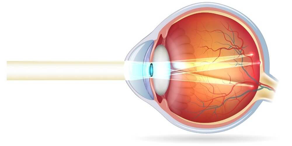Die schematische Darstellung eines Auges bei Astigmatismus